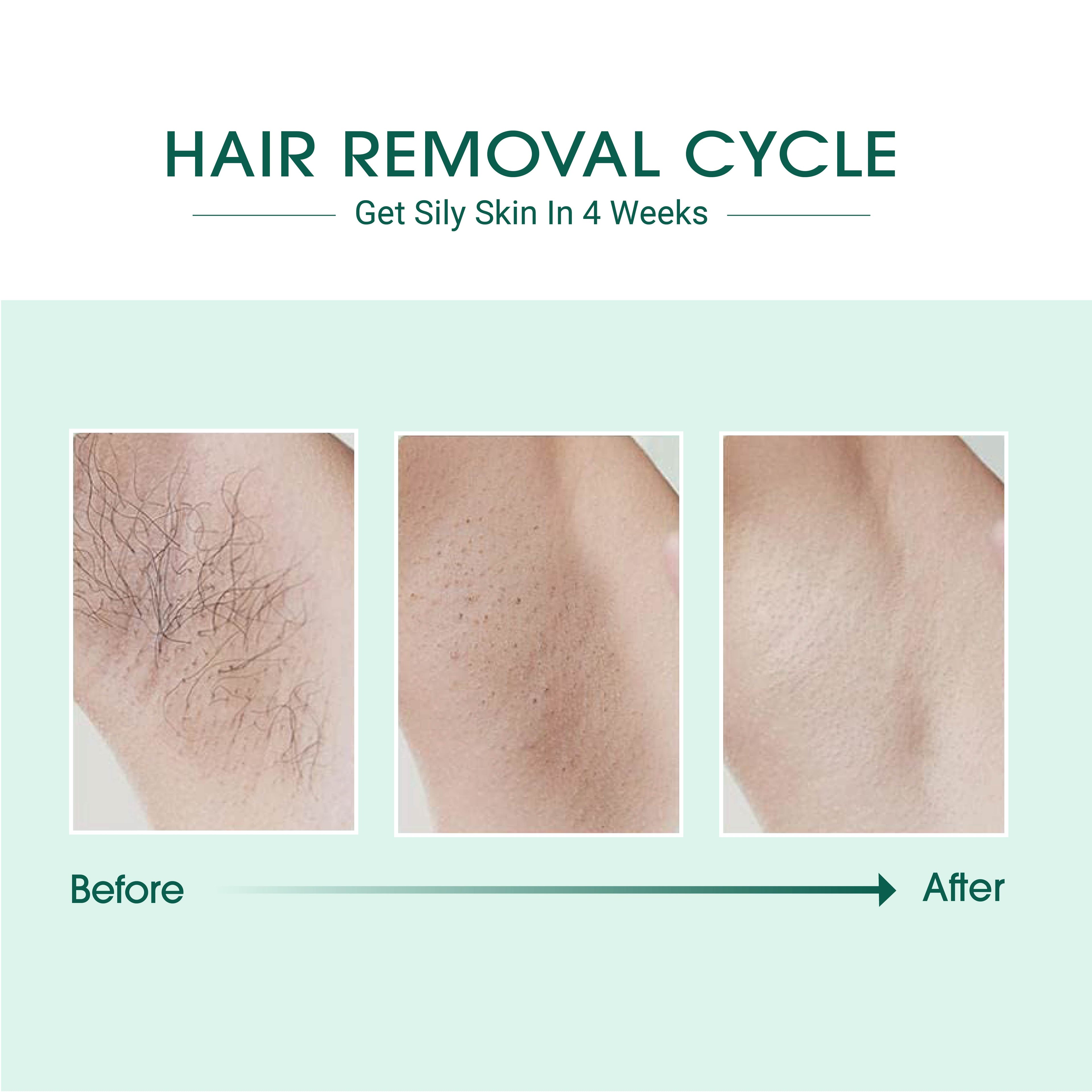 IPL Laser Hair Removal Device – Permanent Smoothness at Home